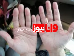 دلایل احتمالی ورم انگشتان دست